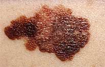 A skin melanoma